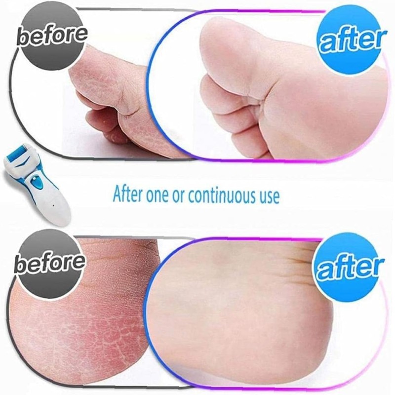 Personal Pedi Foot Care – Smooth & Soft Feet at Home